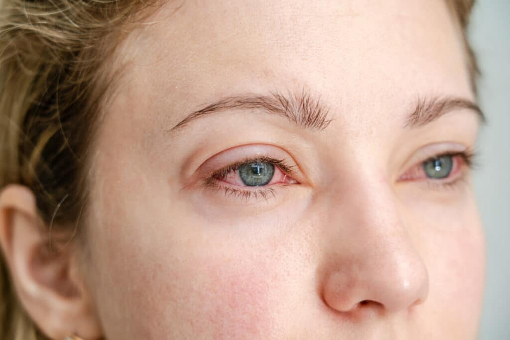 A close-up image of a woman with red, irritated eyes showing allergy symptoms, who might need laser treatment for retinopathy.