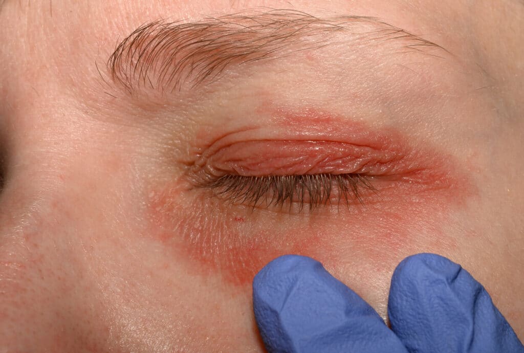 A picture of a girl with red skin around her eyes being examined by a specialist during her eye allergy treatment.