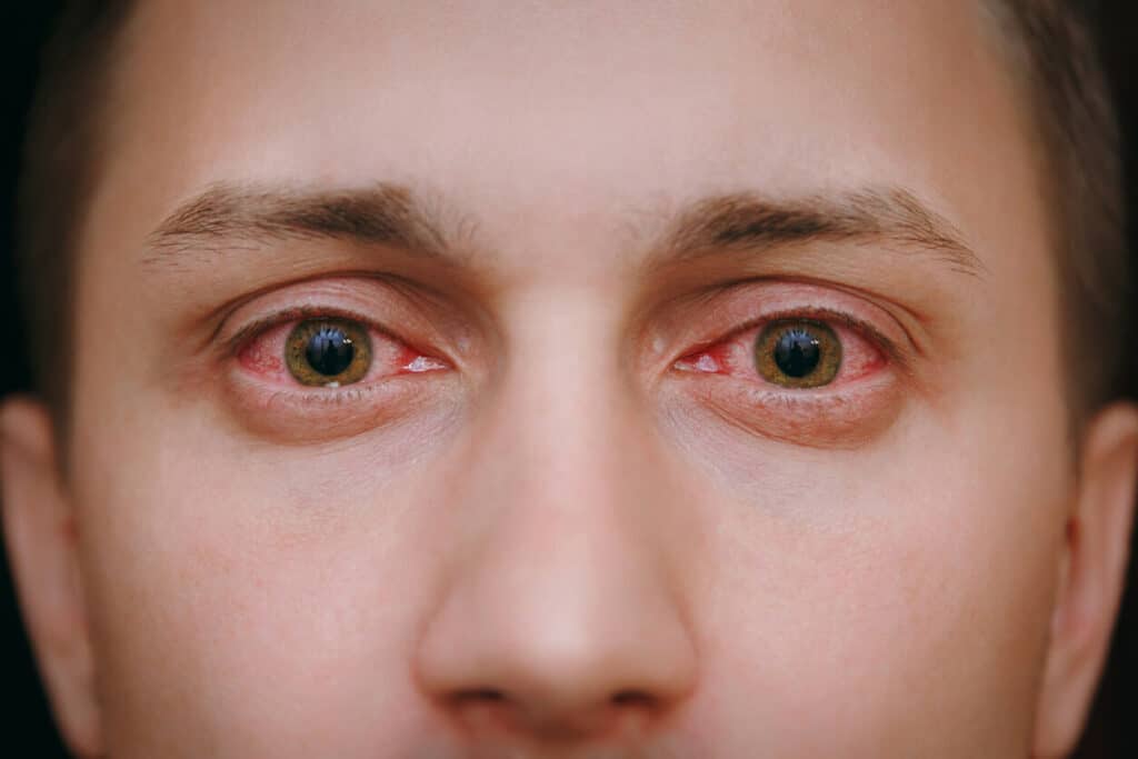 A close-up of a man's red, bloodshot eyes caused by eye allergies.