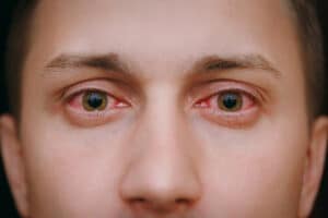 A close-up of a man's red, bloodshot eyes caused by eye allergies.