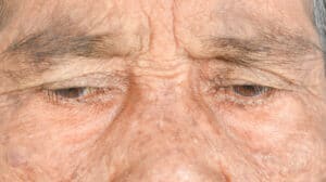 An under-eye bag of an elderly woman exhibiting signs of age-related macular degeneration.