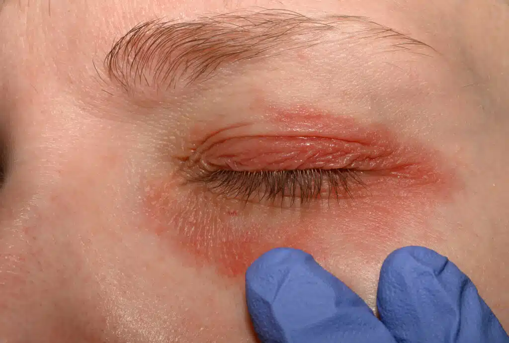 A picture of a girl with red skin around her eyes being examined by a specialist during her eye allergy treatment.