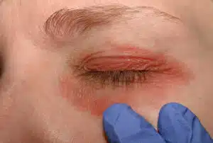 A picture of a girl with red skin around her eyes being examined by a specialist during her eye allergy treatment.