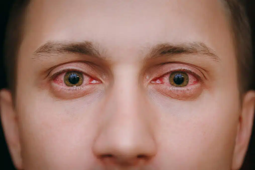 A close-up of a man's red, bloodshot eyes caused by eye allergies.
