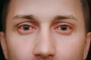 A close-up of a man's red, bloodshot eyes caused by eye allergies.